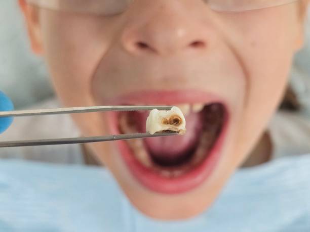 Best Emergency Wisdom Teeth Removal in Largo, FL